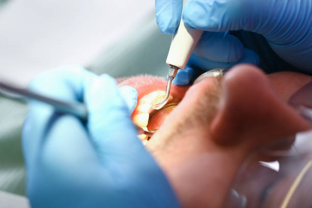 Best Emergency Wisdom Teeth Removal in Depoe Bay, OR